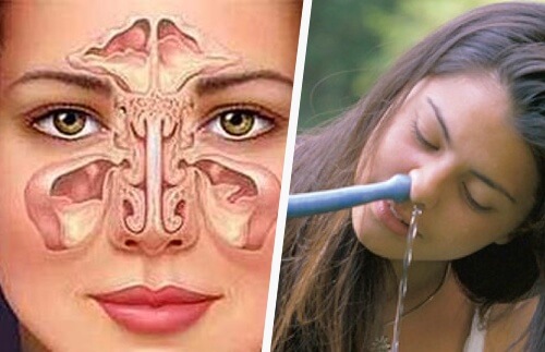 Simple and Natural Ways to Treat Sinusitis