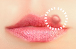 10 Natural Treatments for Cold Sores