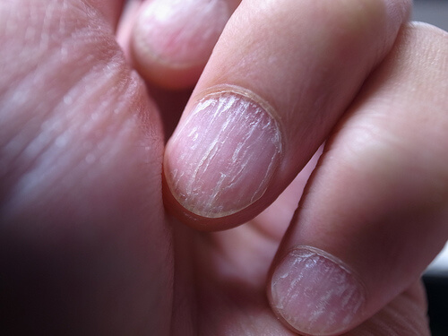 nail fungus