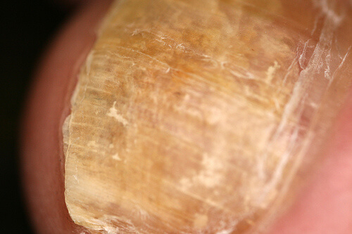 causes and treatments for nail fungus