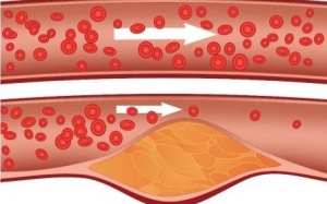 Herbalist products to reduce cholesterol naturally