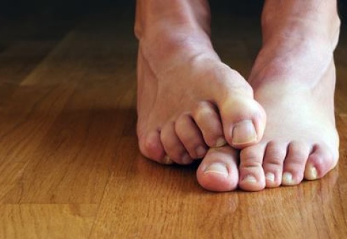 toenail fungus