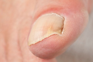 How to Treat Common Nail Problems