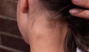What Should You Do About Swollen Lymph Nodes?