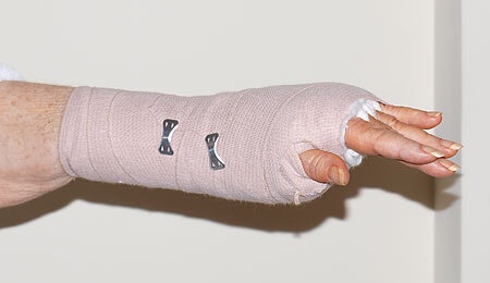 A lady's wrist in a splint