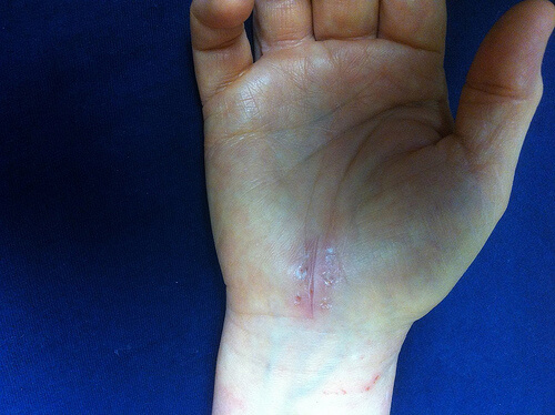Hand affected by carpal tunnel syndrome