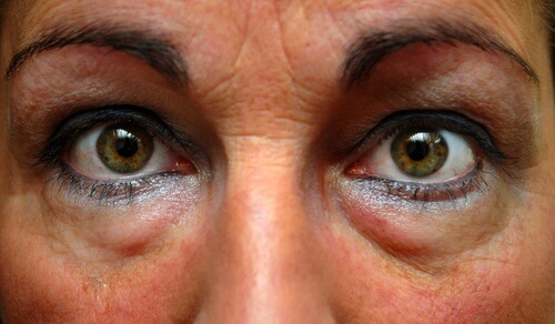 Under eye bags bags under your eyes