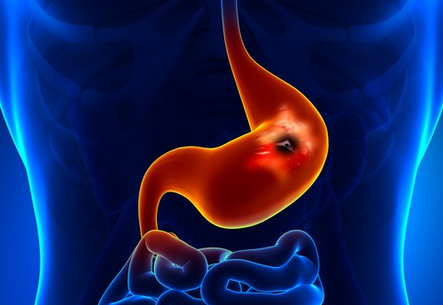 Colored anatomical image of the stomach showing an ulcer causes of stomach aches