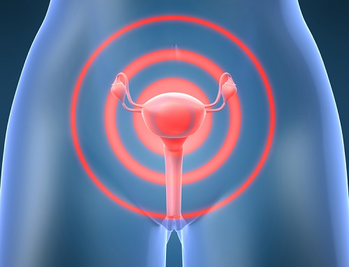Cervical cancer