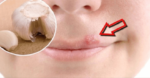 Home Remedies to Heal Cold Sores Fast