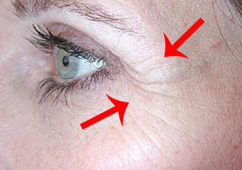 Crow's feet next to eyes exercises to tone your face