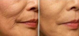 Before and after