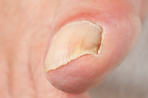 A closeup of a toenail.