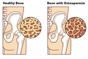 Eight Foods that May Help Reduce Your Risk of Osteoporosis