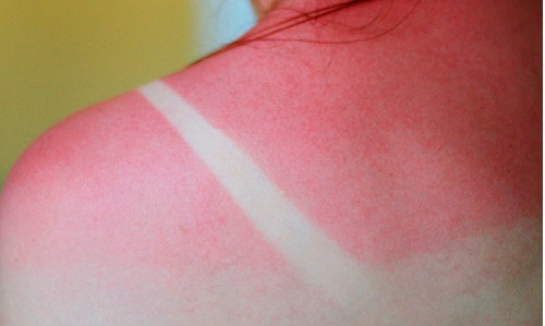 7 Effective And Natural Remedies for Sunburns