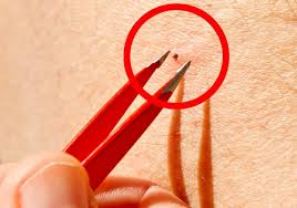 How to Remove Fleas and Ticks Naturally
