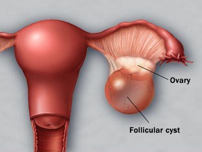 1 ovary