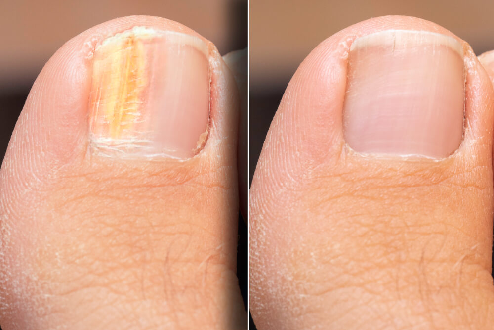 7. The Best Nail Polish for Toenail Fungus - wide 4