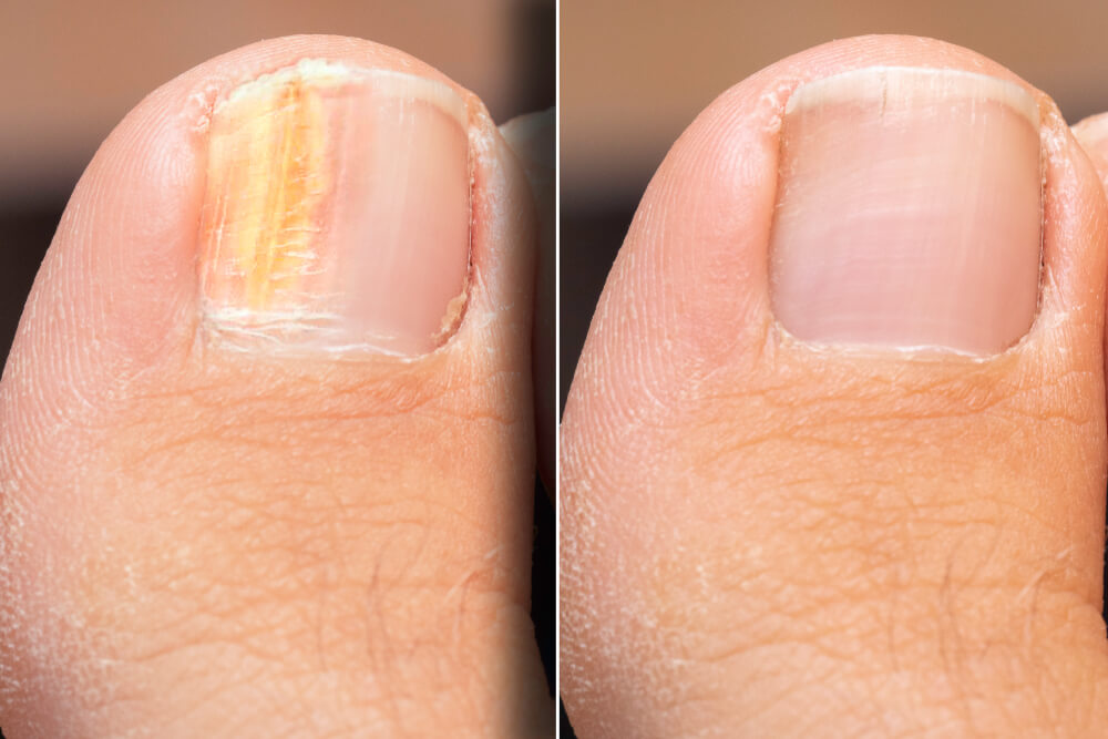 causes-and-treatments-for-nail-fungus-onychomycosis-step-to-health