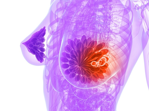 2 breast cancer