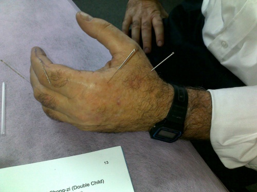 acupuncture
