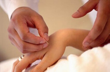 acupuncture, an ancient technique