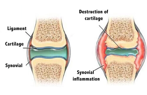 How to Prevent Cartilage Pain