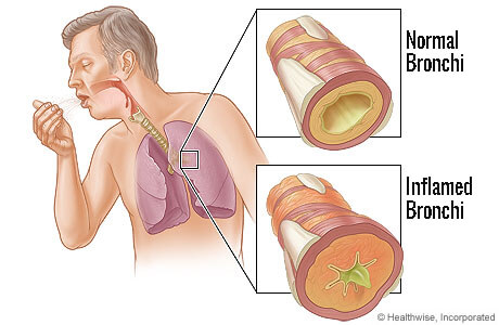 Chronic bronchitis.