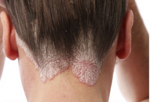 7 Home Remedies to Fight Dandruff and Seborrhea