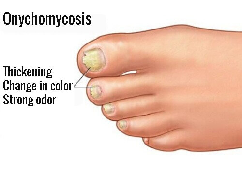 Causes and Treatments for Nail Fungus (Onychomycosis)