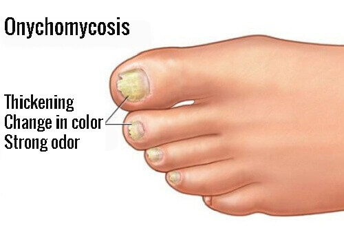 Causes And Treatments For Nail Fungus Onychomycosis Step To Health