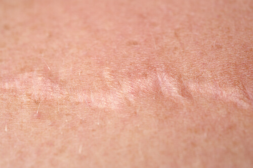 Light scar
