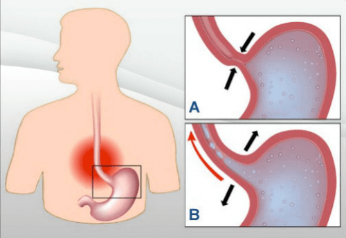 7 Natural Remedies to Treat Acid Reflux 7 Natural Remedies to Treat Acid Reflux