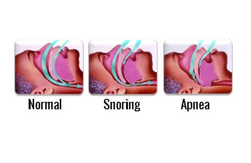 Snoring versus normal breathing