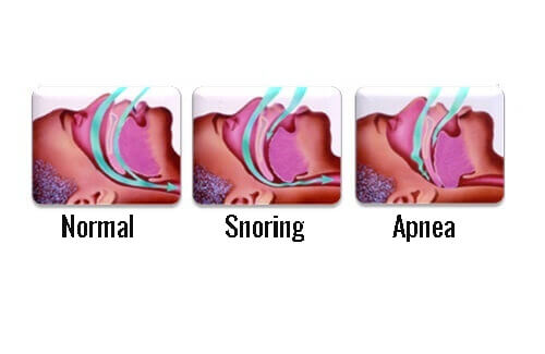 Snoring Explained Interesting Facts About Snoring You Should Know - Step To Health