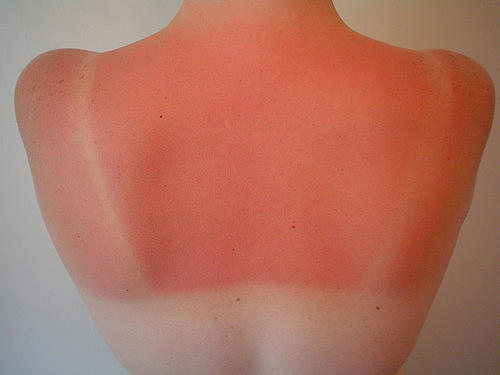 Sunburn