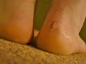Cure Blisters Fast with Natural Remedies