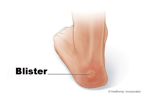 blister on heel