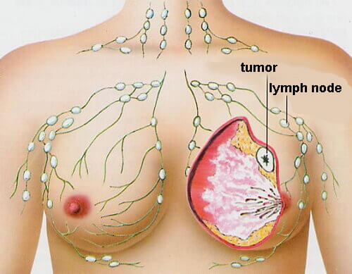 Cancer in Women: The 5 Most Common Types