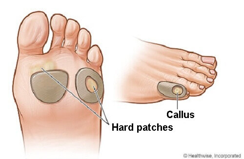 How to Treat Calluses Naturally How to Treat Calluses Naturally