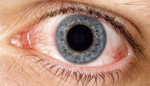 Some Great Natural Remedies for Dry Eyes