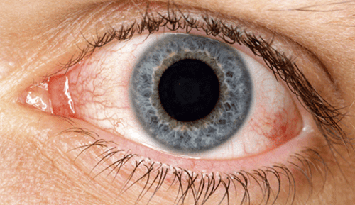 Some Great Natural Remedies for Dry Eyes