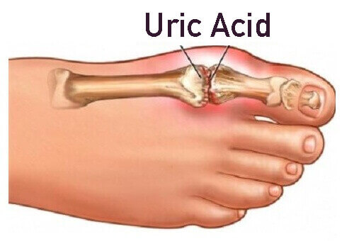 Reduce uric acid naturally foot diagram