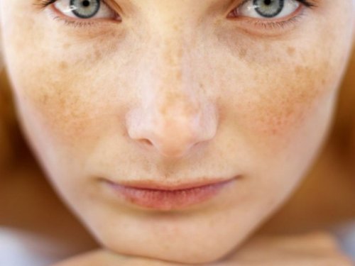 freckles