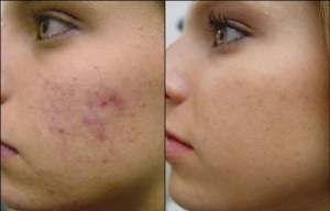 4 Homemade Anti-Acne Facial Masks