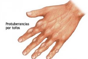 Reduce Uric Acid Naturally