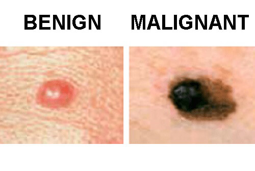 difference between benign and malignant