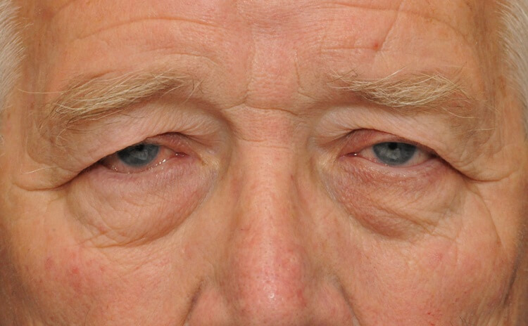 Man with sagging eyelids