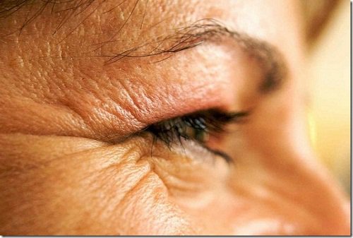 A person with wrinkles around the eyes.