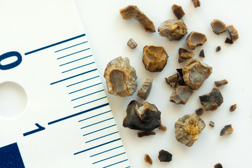 Kidney and bladder stones being measured